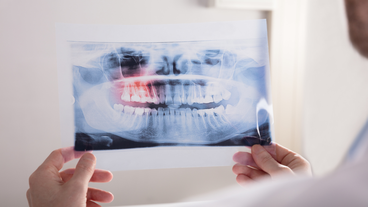 Dental X-Rays and Injury Preventions