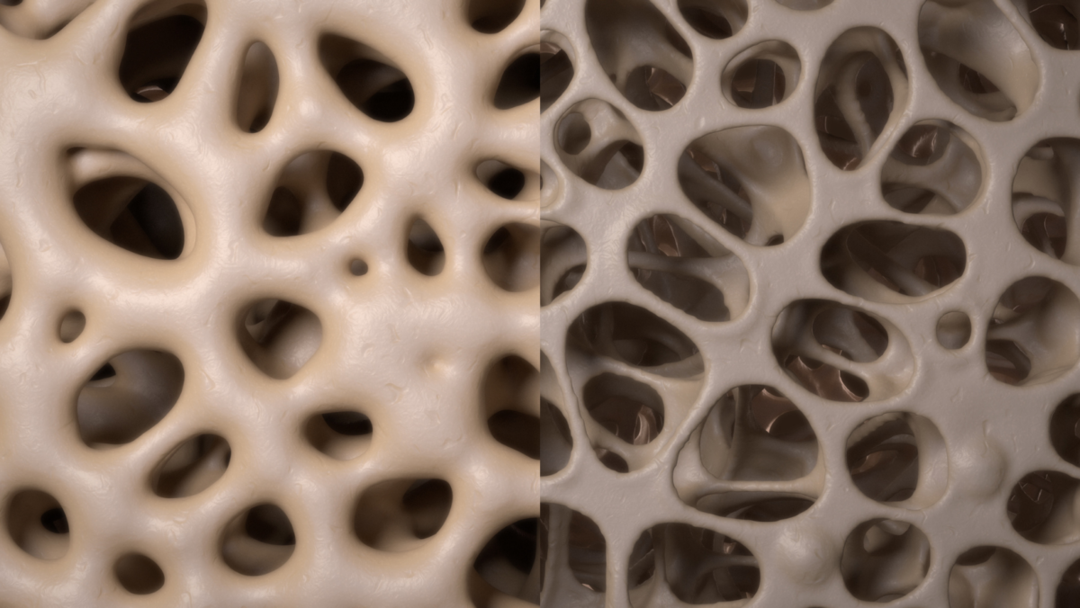 Bone Density