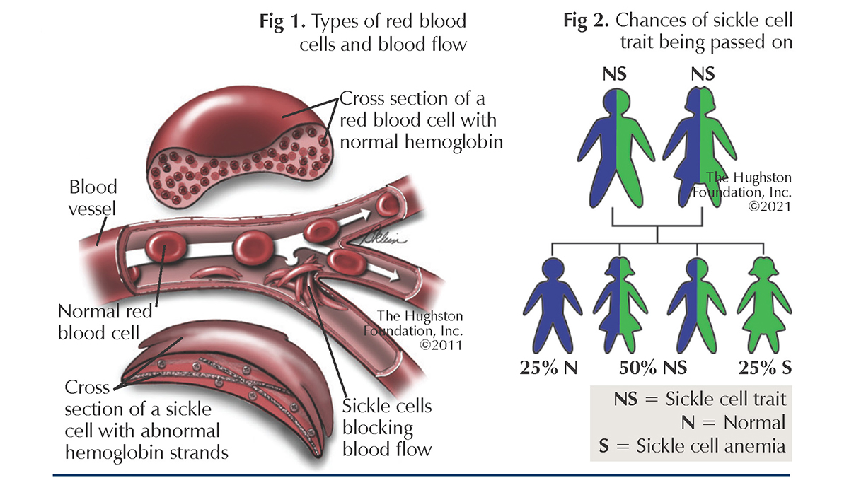 Sickle Cell Diagram