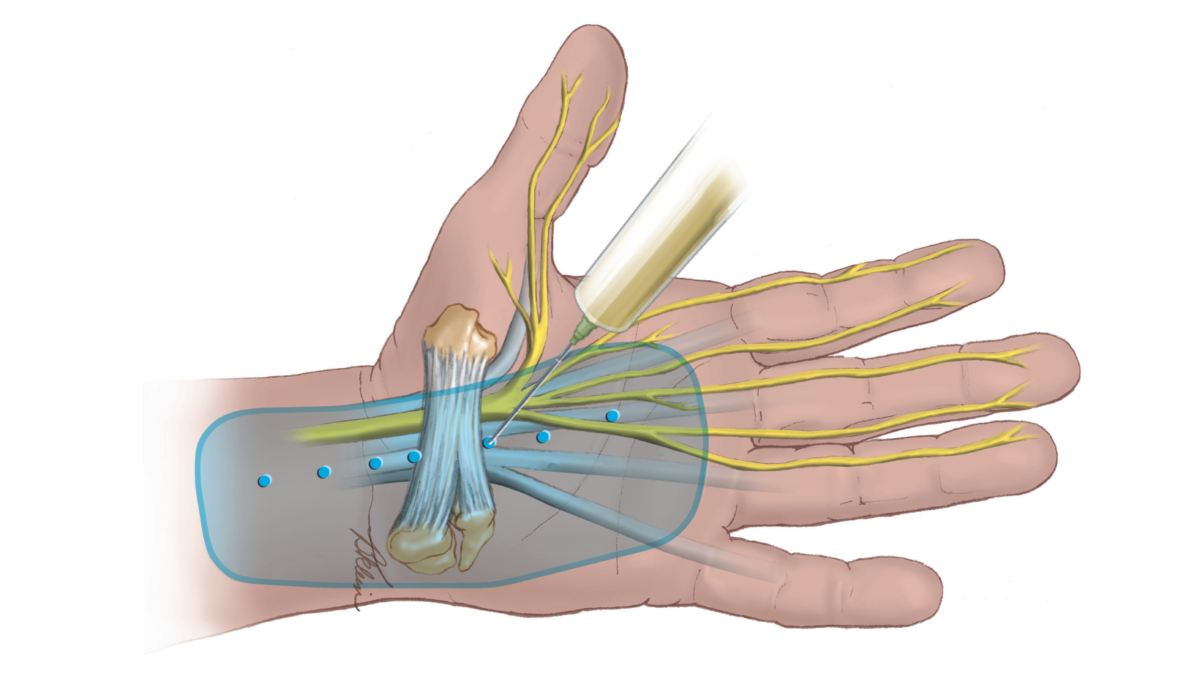 Wide-Awake Local Anesthesia with No Tourniquet: Is WALANT right for you?