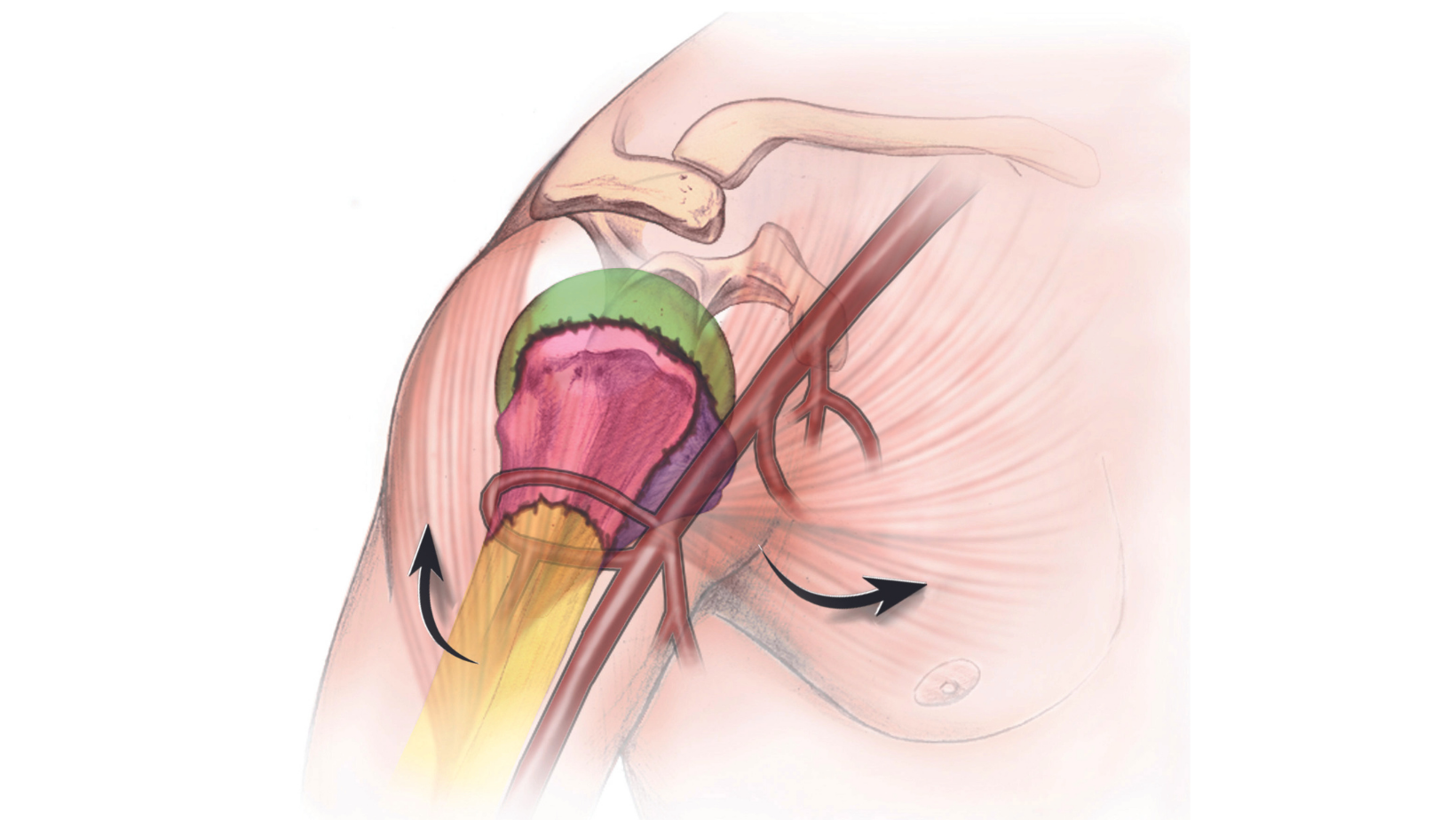 surgical humerus of arm