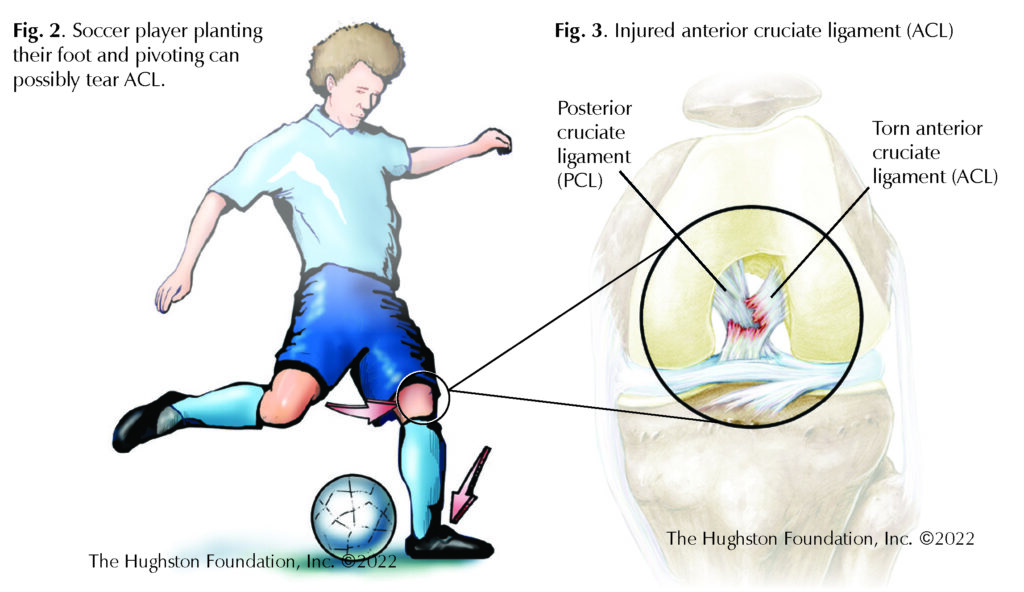 ACL Injuries - Hughston Clinic