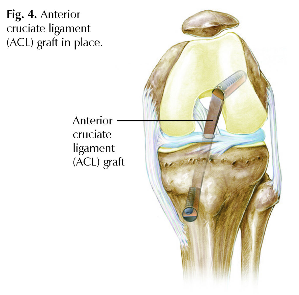 ACL Injuries - Hughston Clinic