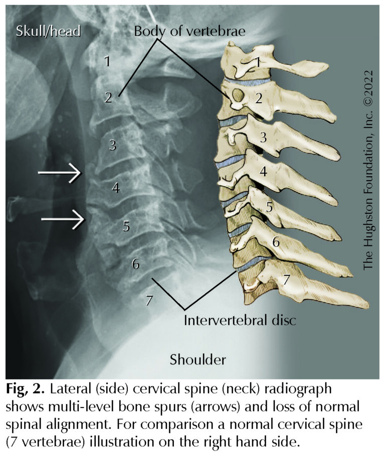 3D-Printing In Cervical Spine Surgery - Hughston Clinic