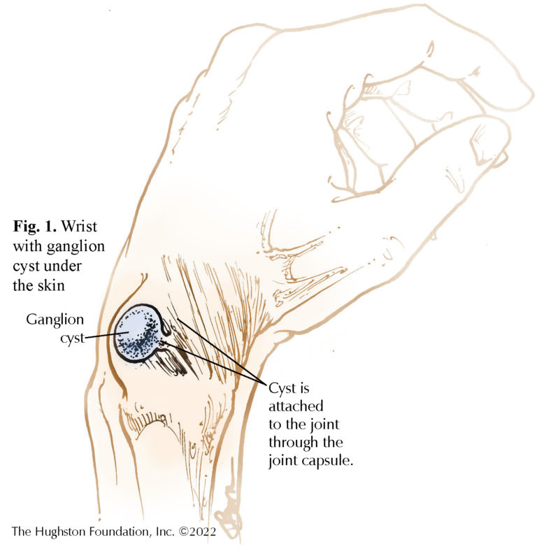 Ganglion Cysts Hughston Clinic ganglion-cysts-hughston-clinic
