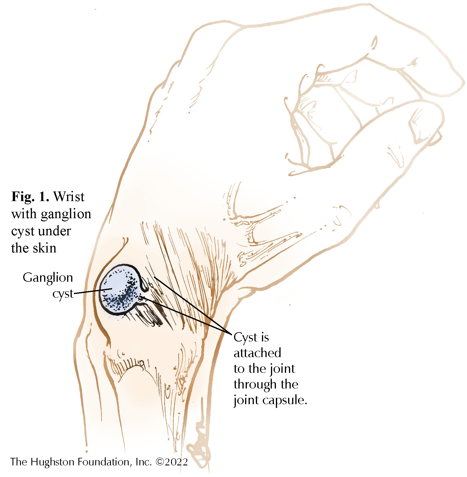 Ganglion Cysts Hughston Clinic 