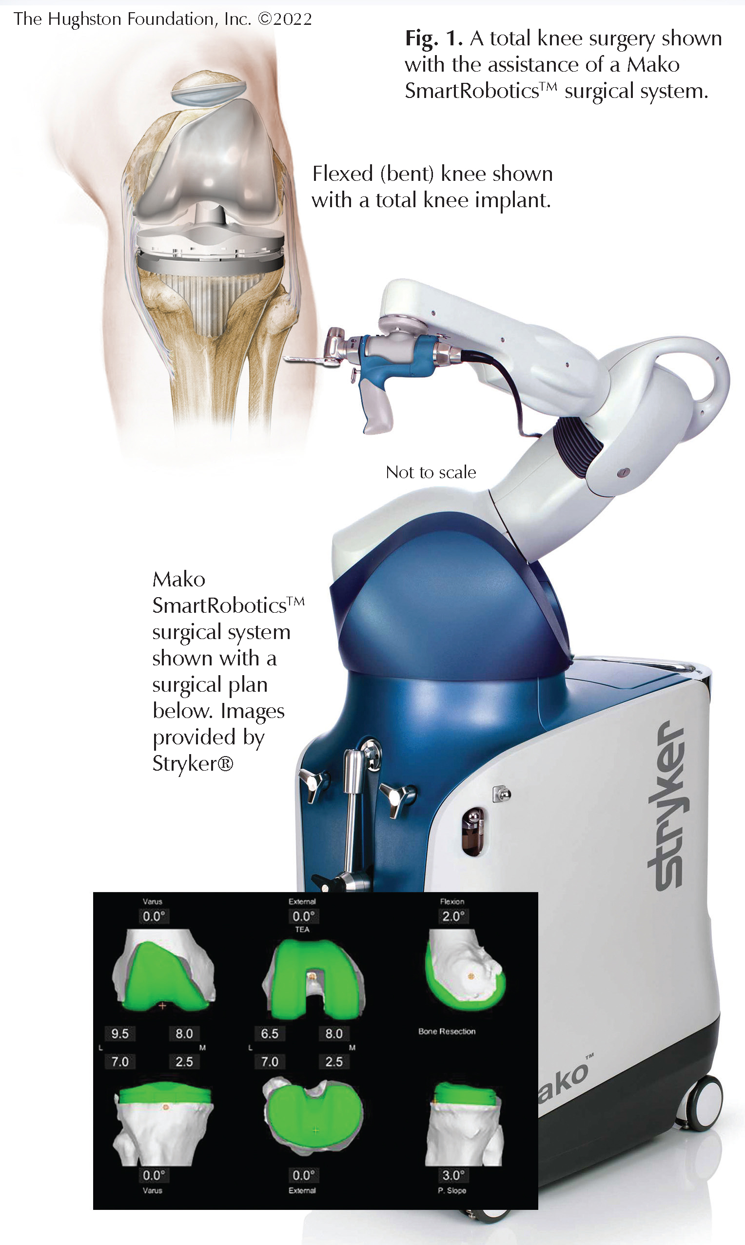 robotic-total-knee-replacement-questions-for-a-specialist-hughston