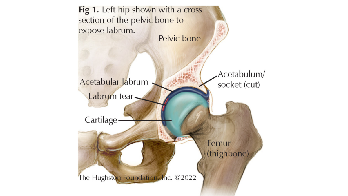 Hip Labral Tear Hughston Clinic 