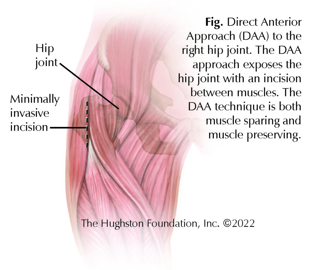 Total Hip Replacement Surgery, Direct Anterior Approach (DAA)