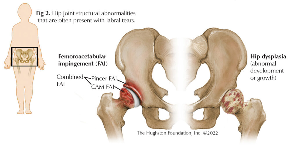 Hip Labral Tear Hughston Clinic