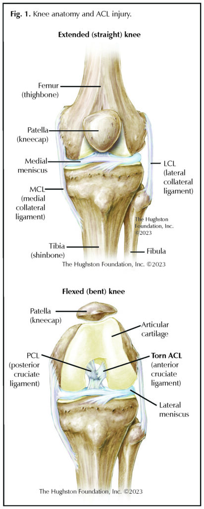 In Perspective: Anterior Cruciate Ligament Tears - Hughston Clinic