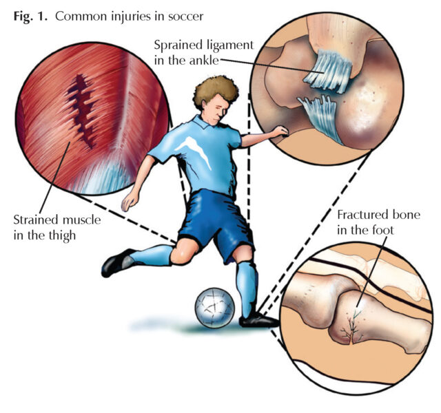 Soccer Players: Sprains, Strains, and Breaks - Hughston Clinic