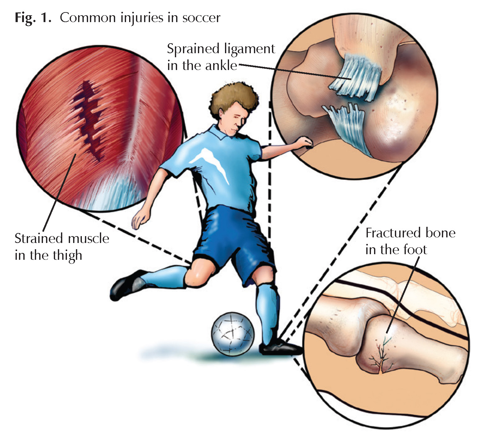 Soccer Players Sprains, Strains, and Breaks Hughston Clinic