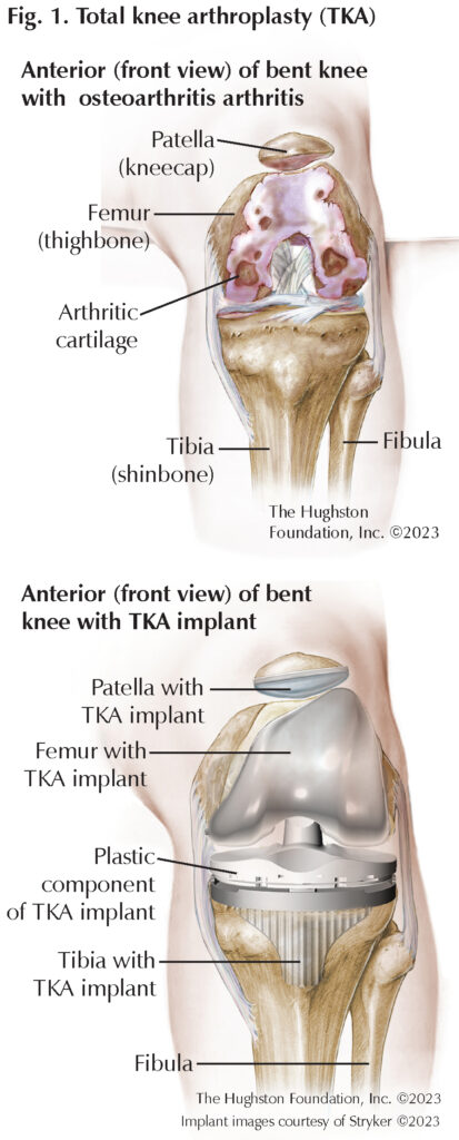 Total Knee Arthroplasty: Questions for a Specialist - Hughston Clinic