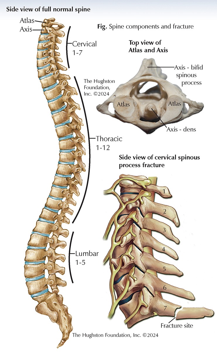 Spinous Process Fractures - Hughston Clinic