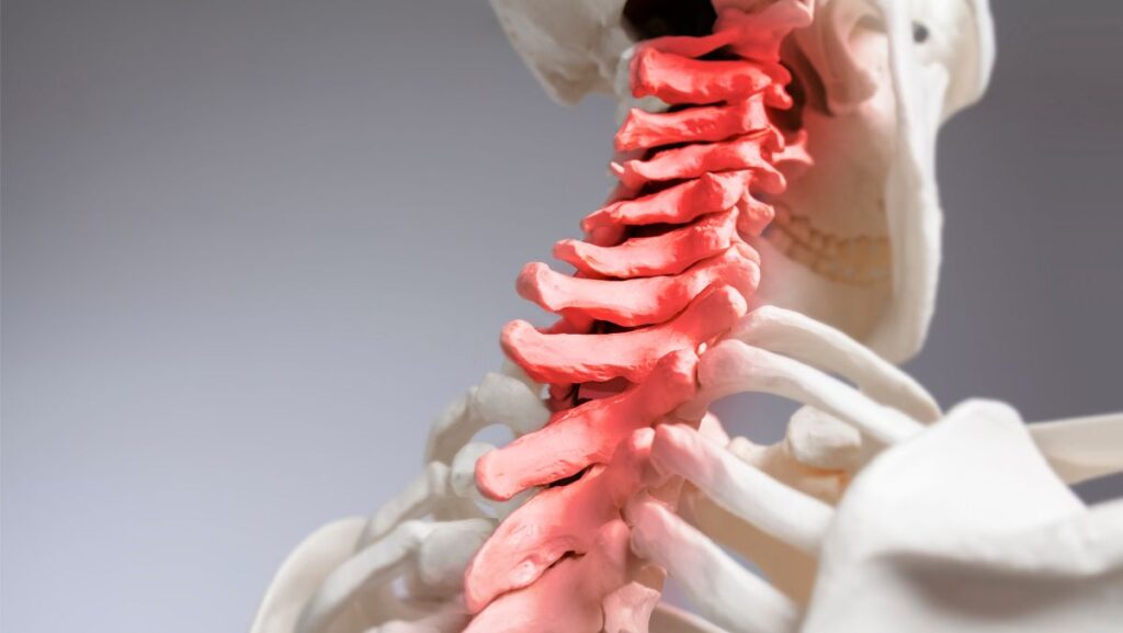 Spinous Process Fractures - Hughston Clinic