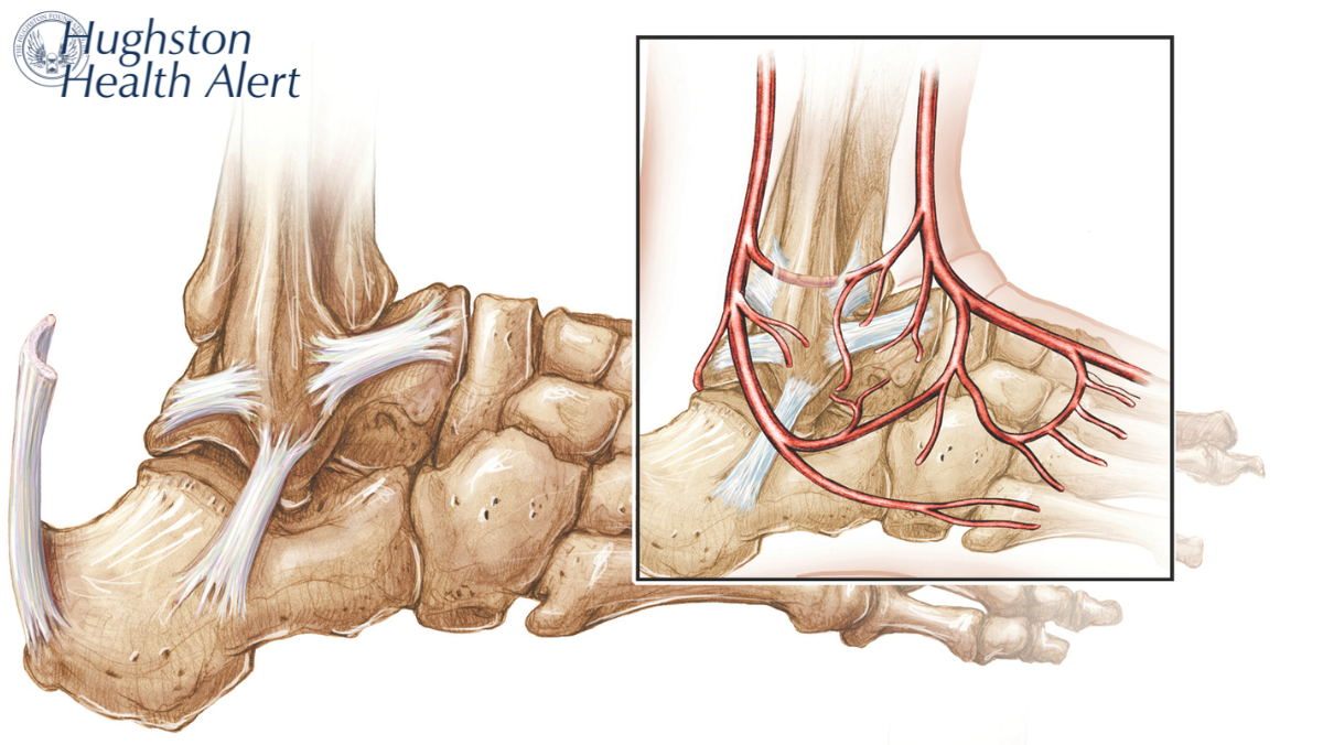 Osteonecrosis of the Foot & Ankle