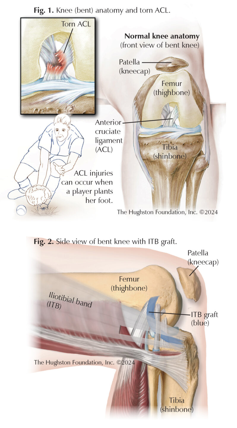 Modified Ellison Let Modified Lemaire Lateral Extra-Articular Tenodesis: Improving ACL ...