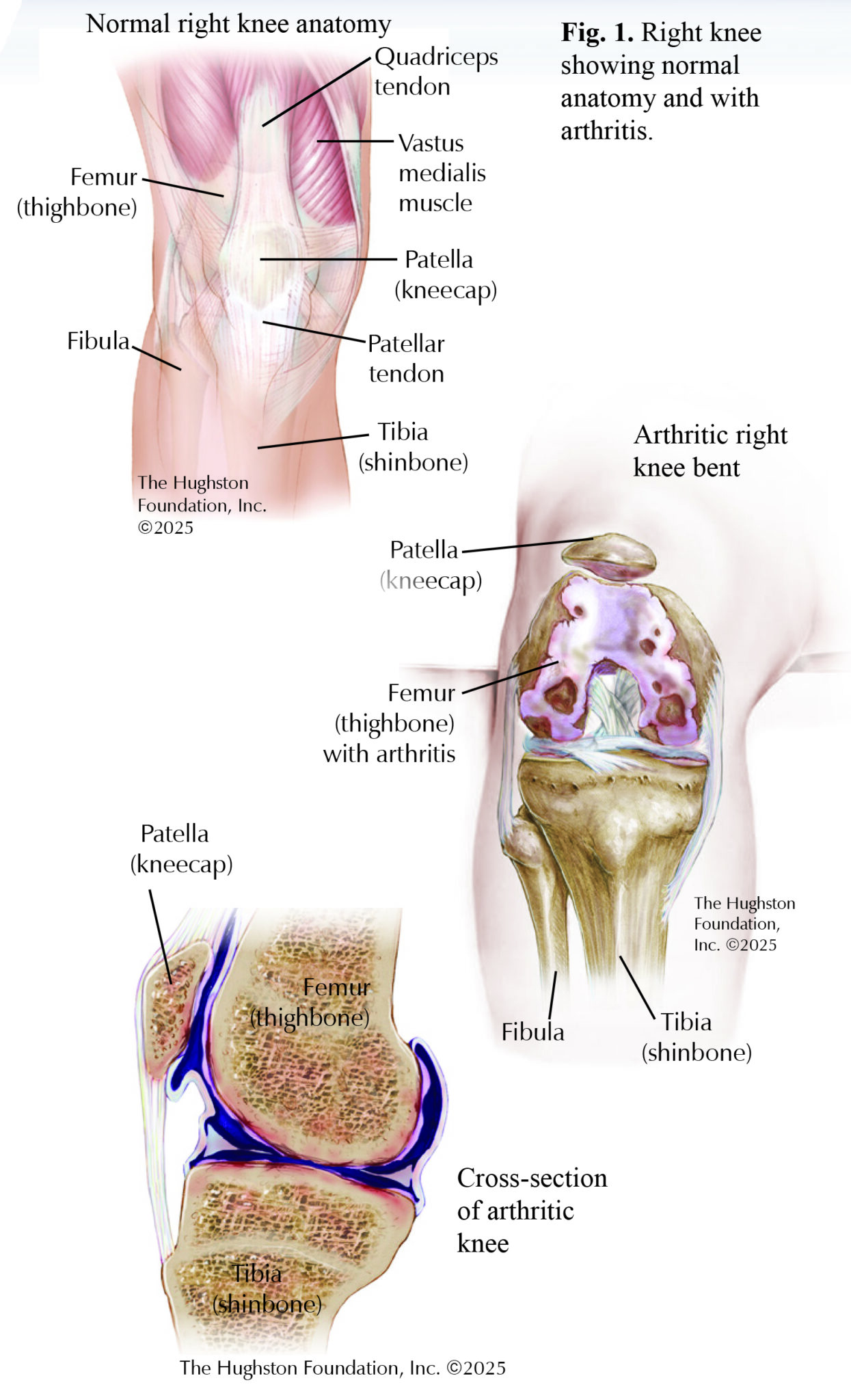 Total Knee Replacement - Hughston Clinic