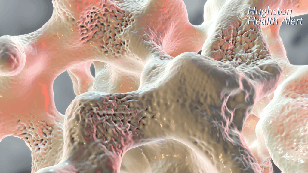 Osteoporosis Information & Treatment | Hughston Clinic